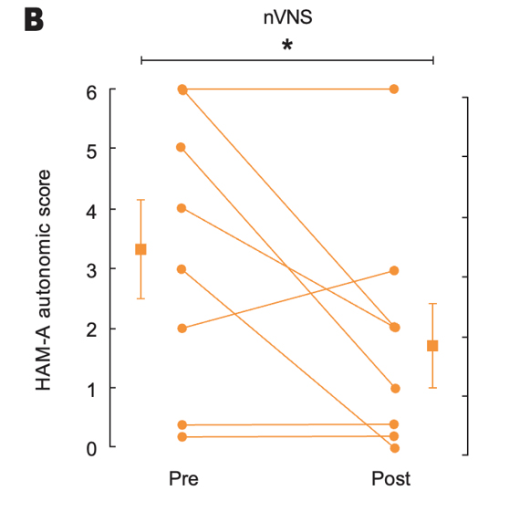 Effects of up to 3 Months of Twice-Daily nVNS or Sham Stimulation on Symptoms of PTSD as Measured